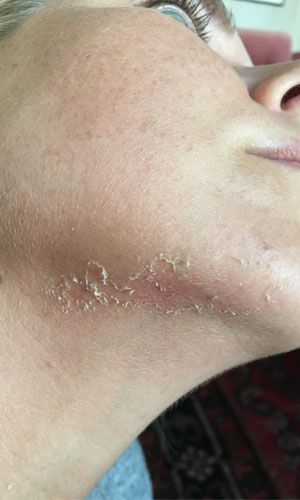 Green Peel Thea