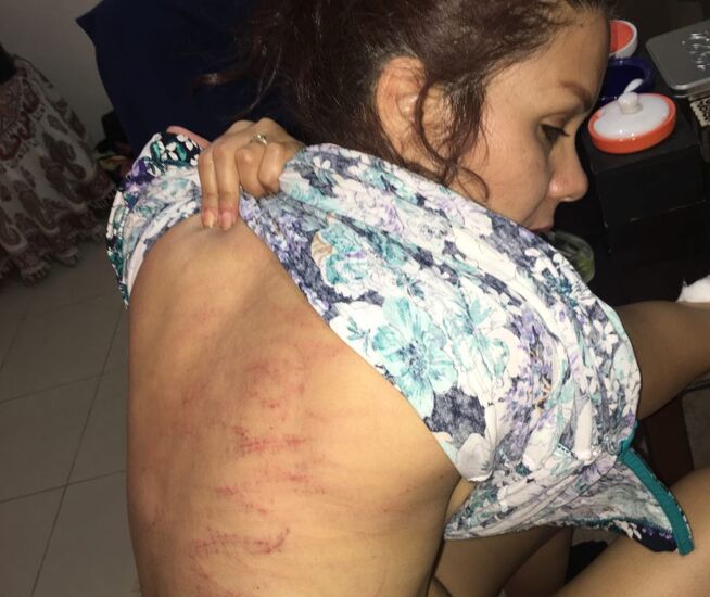 <p>STORE SÅR: Leila Bayat viser her frem sårene på ryggen etter å ha blitt pisket 80 ganger i Iran. Hun har gitt VG tillatelse til å vise bildene.</p>